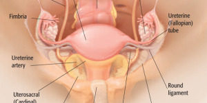 Hysterectomy-300x150