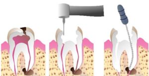 Root-Canal-Treatment