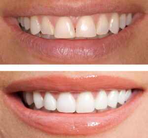 composite-resin-veneers