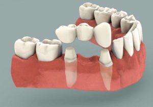 dental-bridge