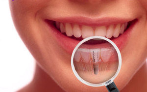 dental-implants