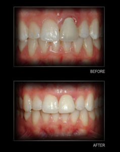 gum-tissue-graft