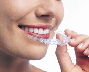 invisalign