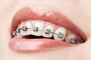 metal-braces